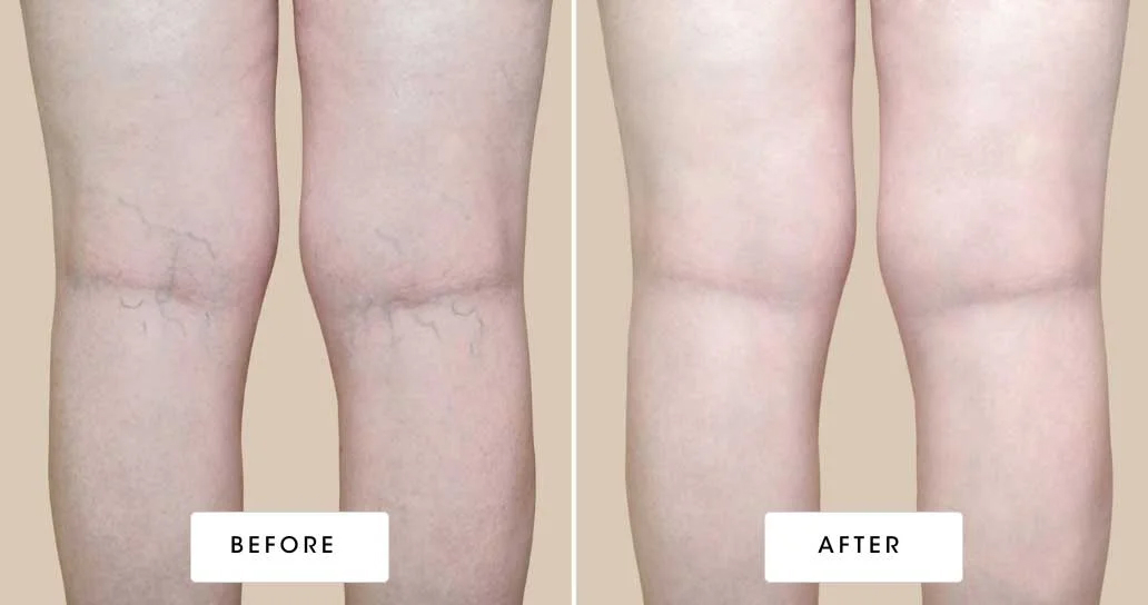 before & after vein treatment 01