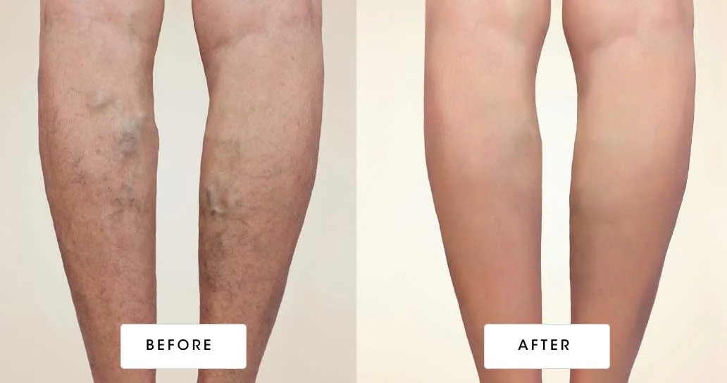 before & after vein treatment 03