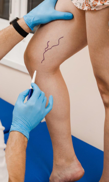 Sclerotherapy for varicose veins