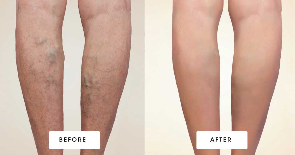 before & after vein treatment 01