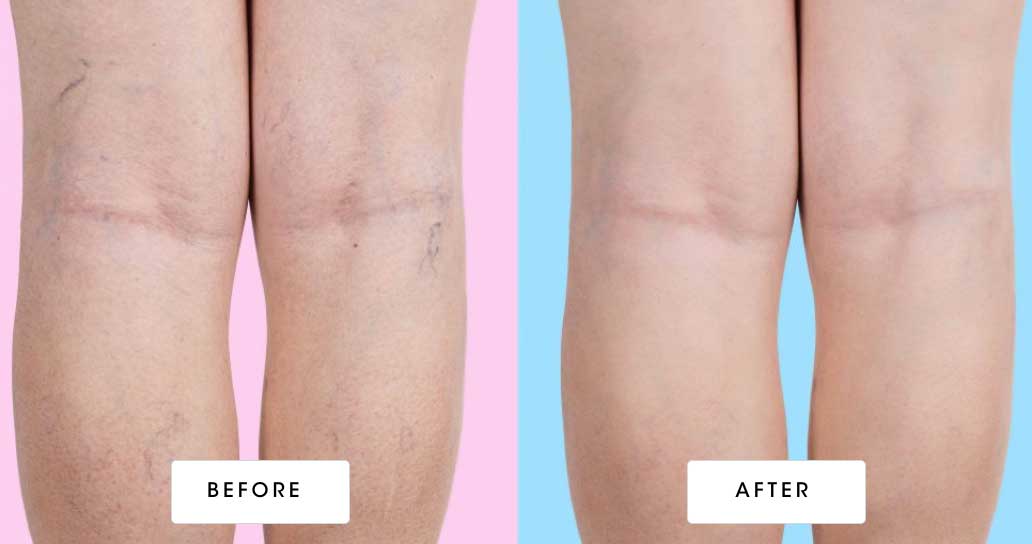 before & after vein treatment 02