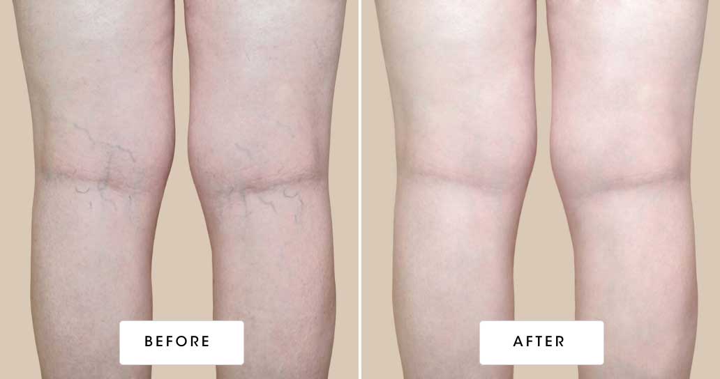 before & after vein treatment 03
