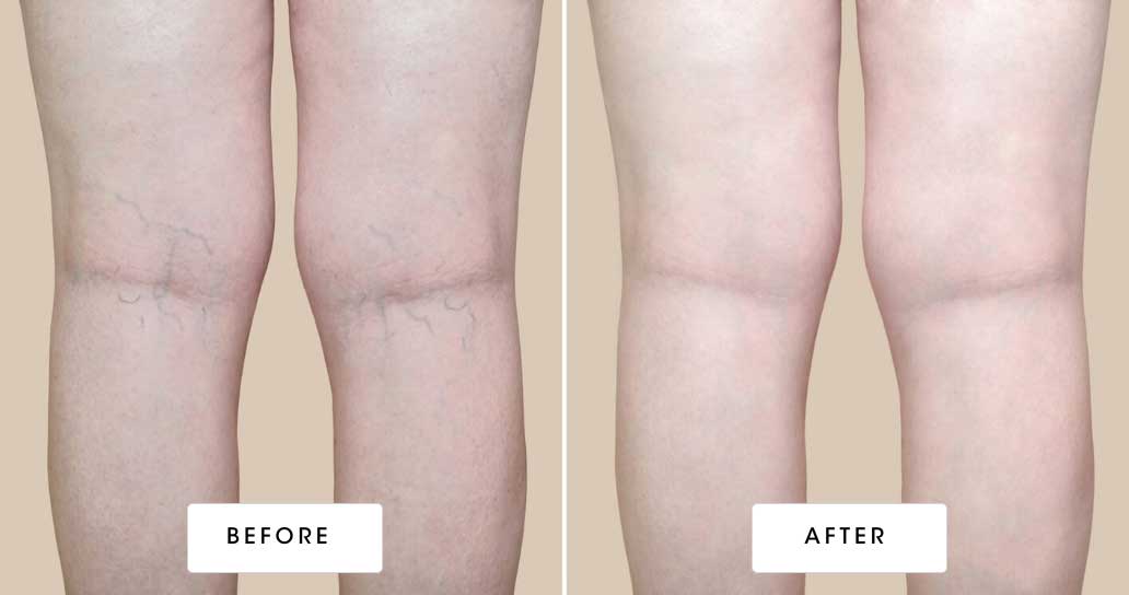 before & after vein treatment 03