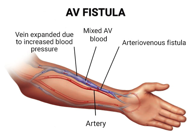 AV Fistula Creation in Brooklyn, NY & Bronx, NY - Vein & Endovascular Medical Care