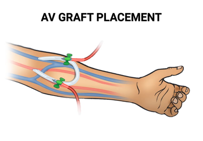 Graft Dialysis Dialysis Shunt Graft Catheter Illustration Stock Photo Graft Dialysis Dialysis Shunt Graft Catheter Illustration Stock Photo