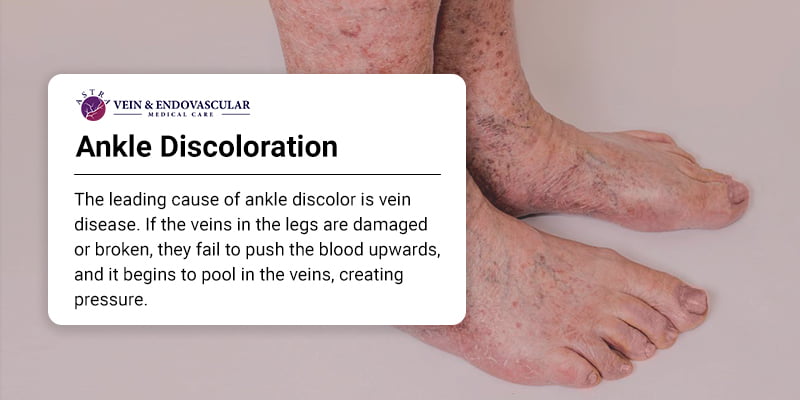 Ankle Discoloration