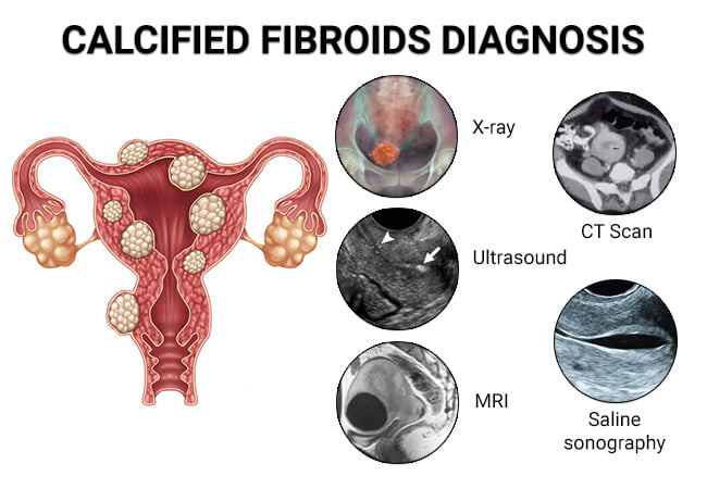 Calcified Fibroids uterine diagnosis