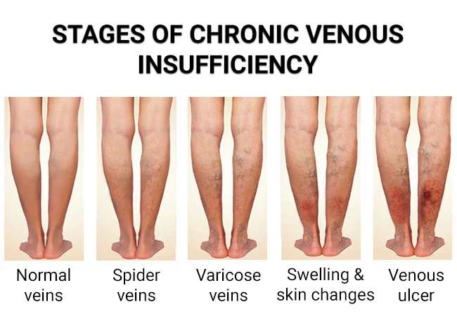 Understanding Chronic Venous Disease: Causes and Symptoms