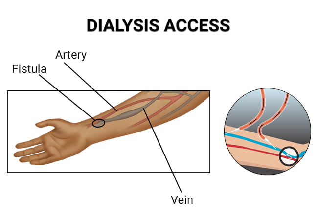 Dialysis Access