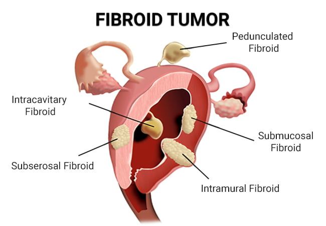 Fibroid Tumor