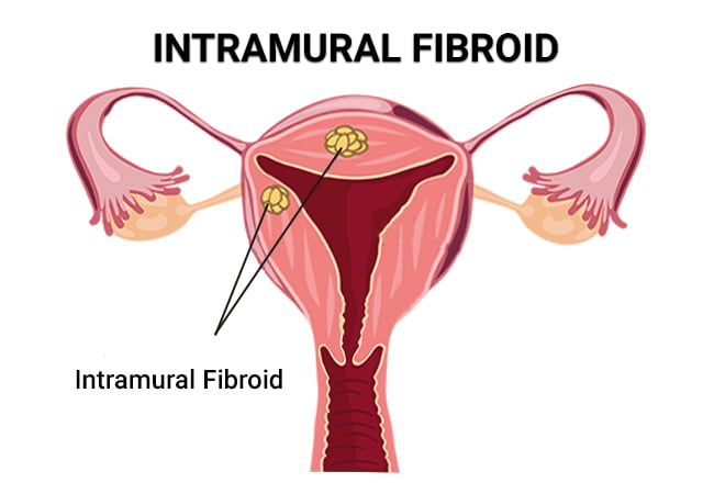 Intramural Fibroid