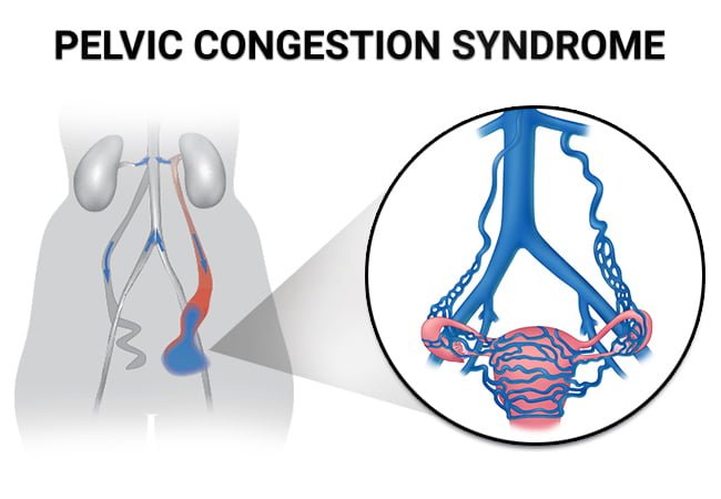 Pelvic Congestion Syndrome (PCS) Treatment - Vein & Endovascular