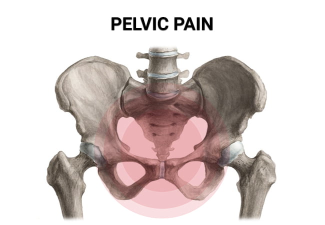 Pelvic Pain
