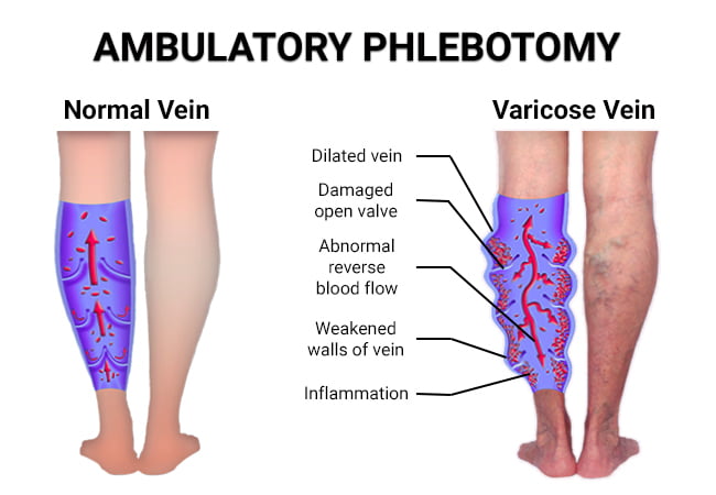 Ambulatory Phlebotomy