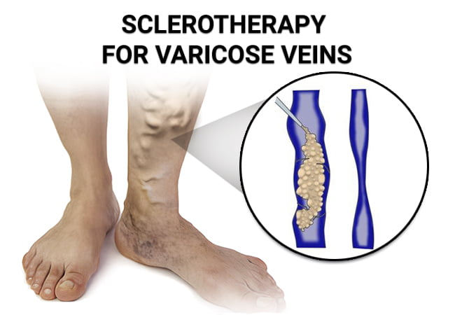 Sclerotherapy For Varicose Veins Vein And Endovascular Medical Care