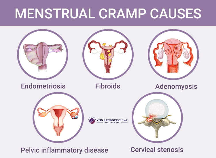 Severe Menstrual Cramps Causes