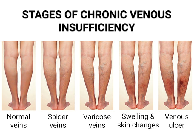 Stages of Common vein conditions
