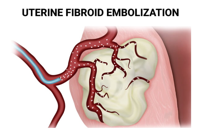 Uterine Fibroid Embolization