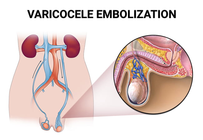 Varicocele Embolization