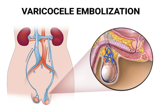 Varicocele