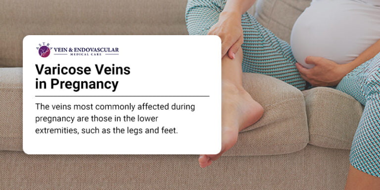 Bulging Painful Leg Veins During Pregnancy Can They Be Treated Vein Endovascular Medical