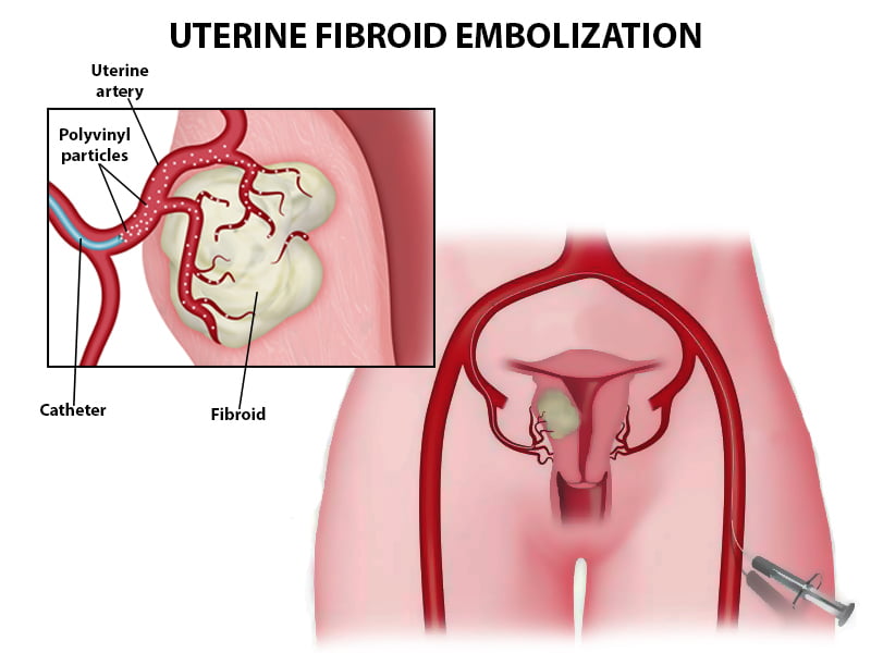 Fibroid Treatment