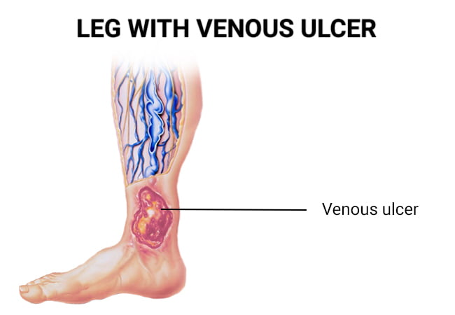 venous stasis ulcer
