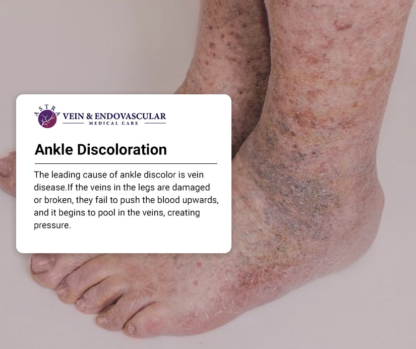 Ankle Discoloration: Causes and Treatment Options - Vein