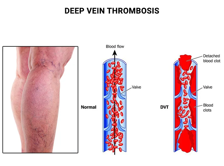 Deep Vein Thrombosis  Symptoms, Signs, Treatment