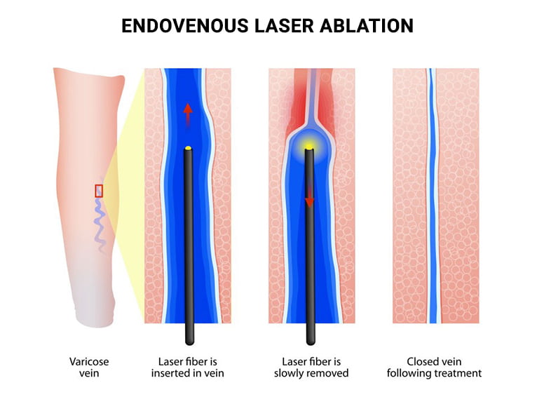 Endovenous Laser Ablation Evla Evlt Vein And Endovascular Medical Care