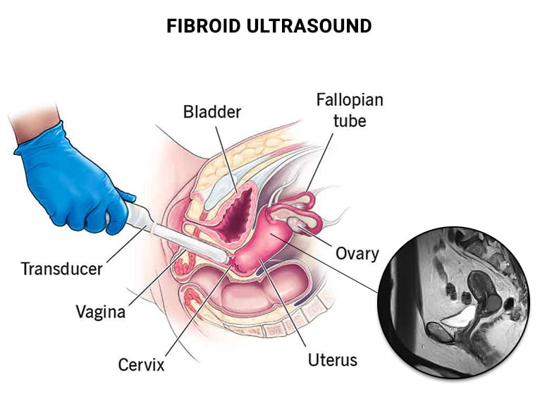 Fibroid Ultrasound