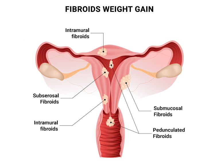 Fibroids Weight Gain