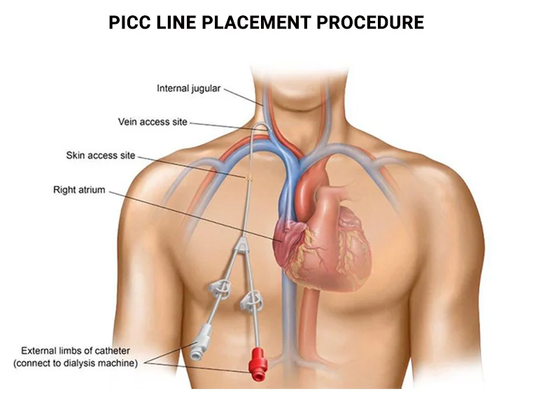 Port or PICC Line Placement - Vein & Endovascular Medical Care