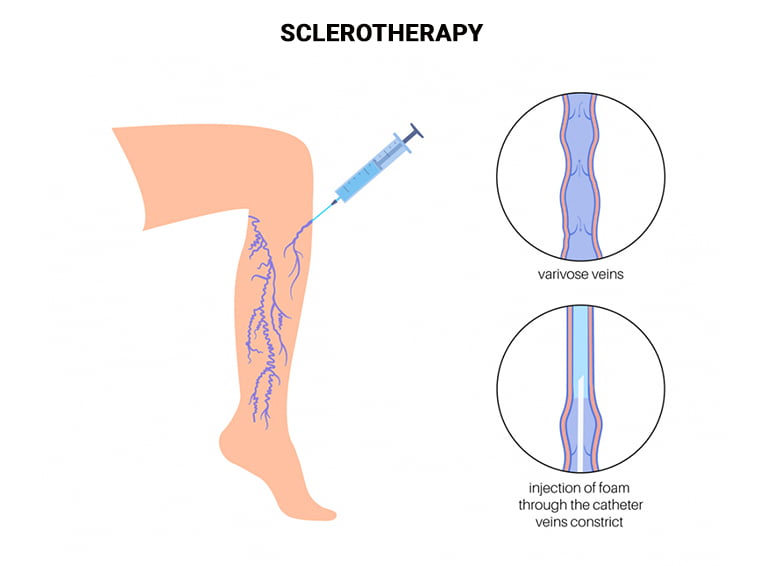 Sclerotherapy