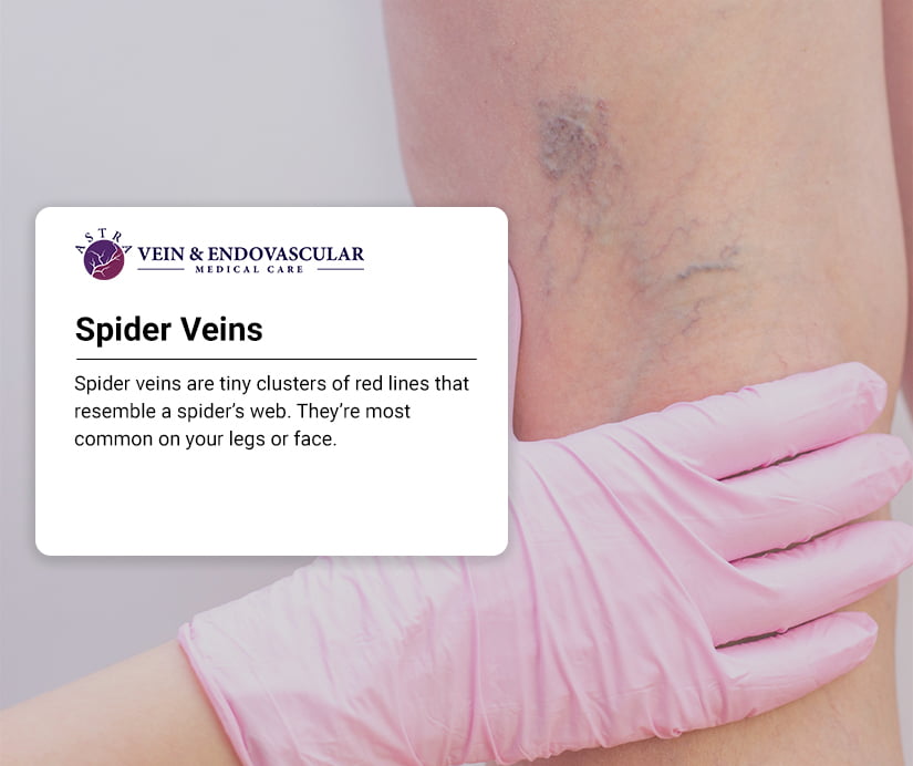Spider Veins