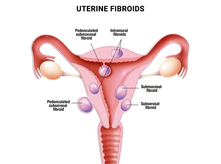 Uterine Fibroids