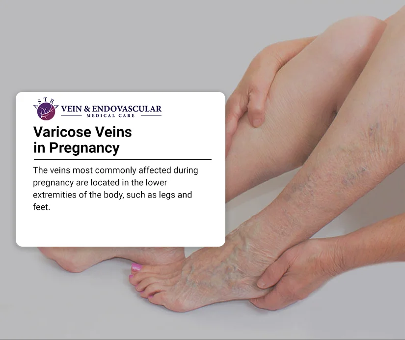 Elevate to Alleviate: How Can Leg Elevation Help During Pregnancy? – Lounge  Doctor