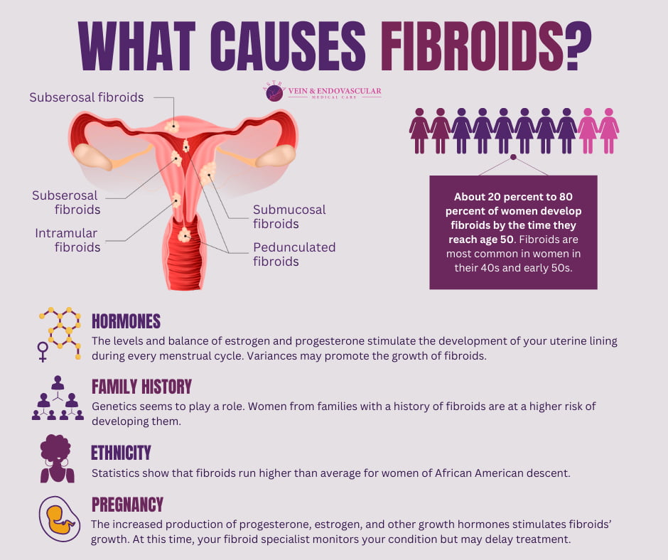 What Causes Fibroids