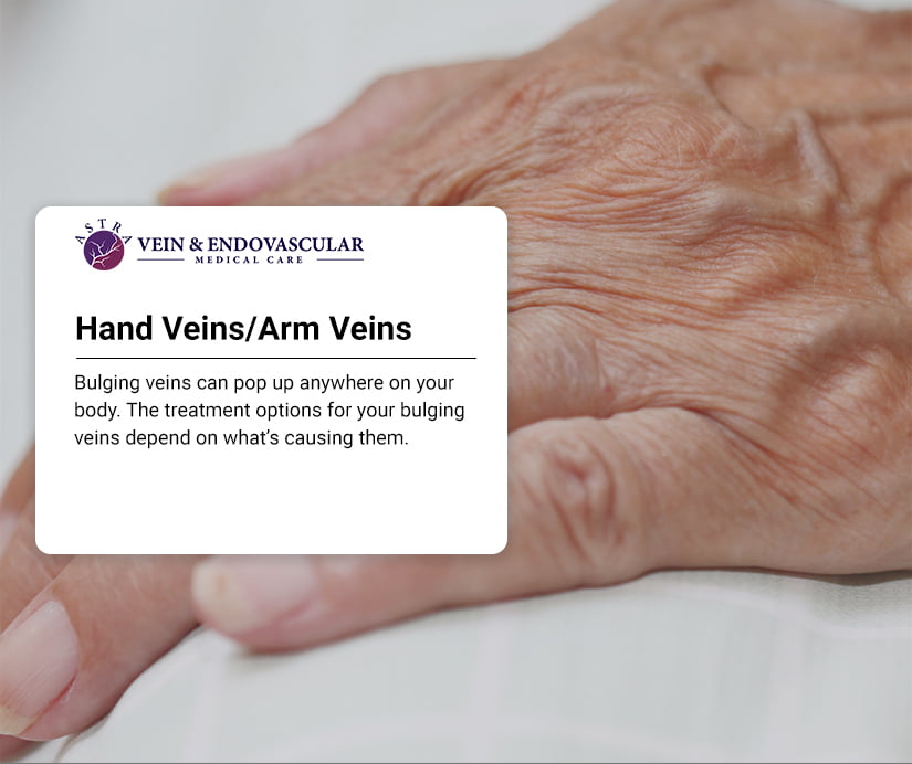 Hand Veins/Arm Veins - Vein & Endovascular Medical