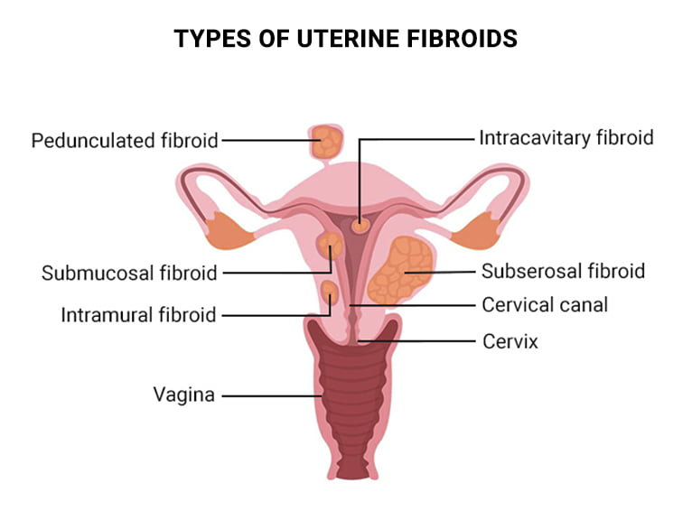 Types of Uterine Fibroids