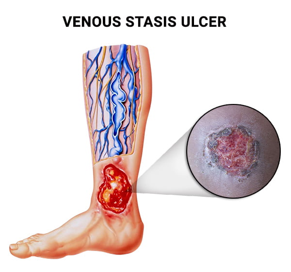 Venous Stasis Ulcer