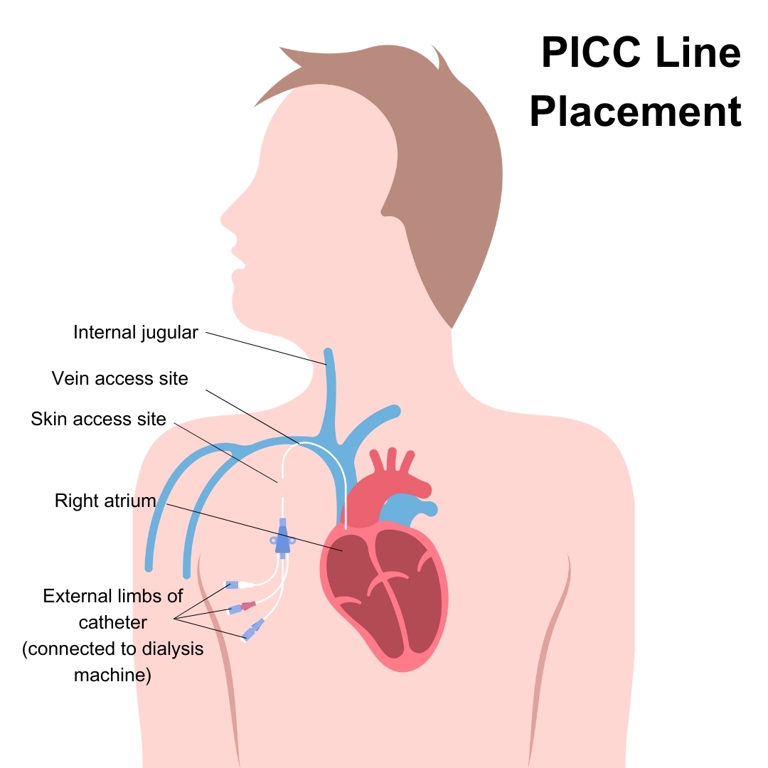Porta Catheter Placement