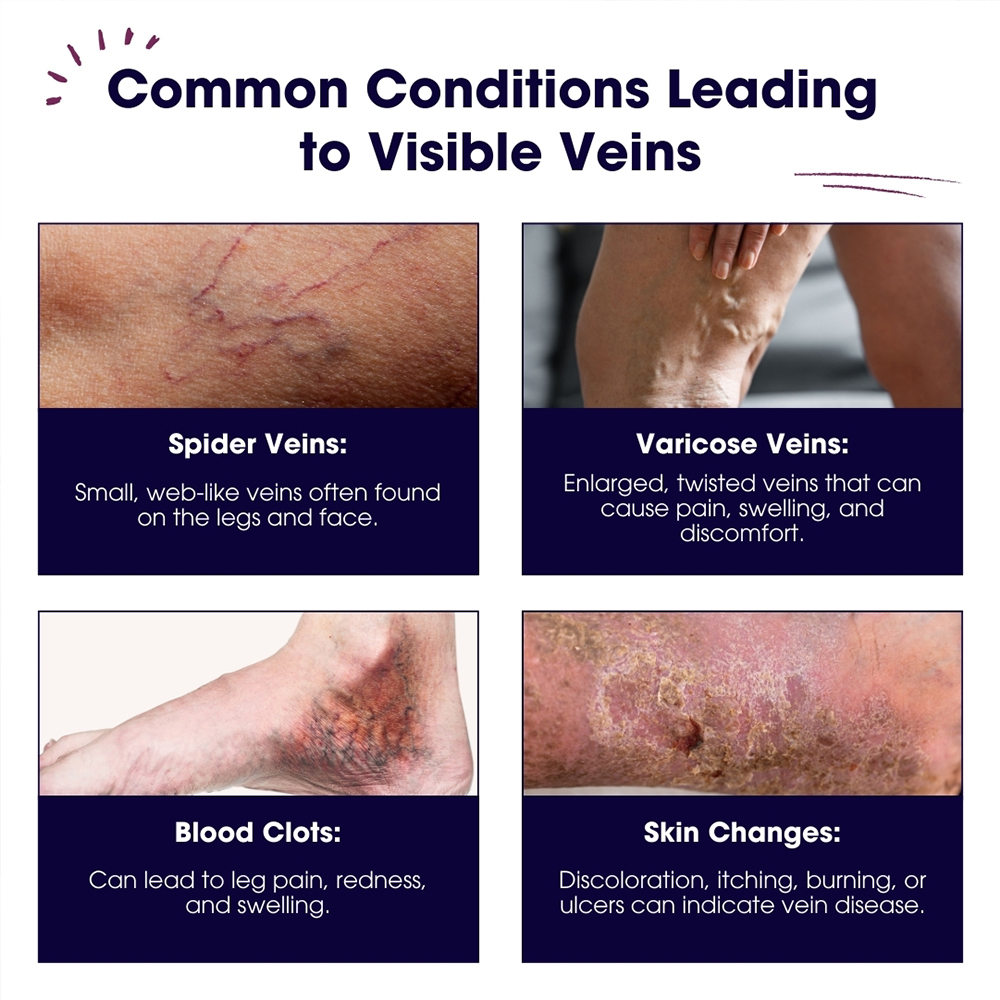 Common Conditions Leading toV isible Veins