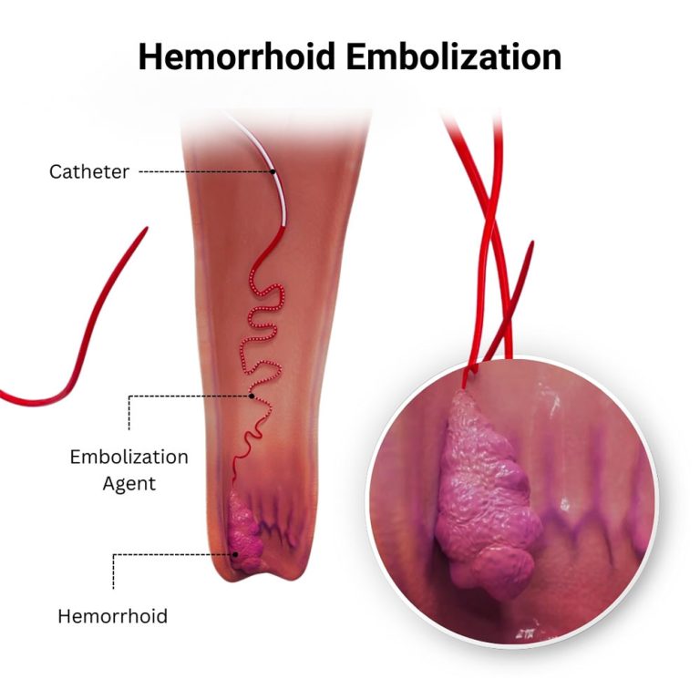 Hemorrhoid embolization near me