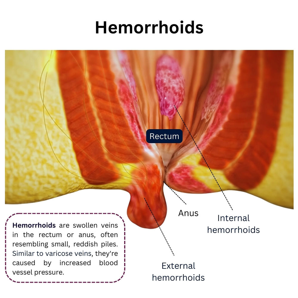 Hemorrhoids