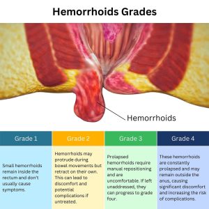 What Do Hemorrhoids Look Like? | Vein & Endovascular Medical Care