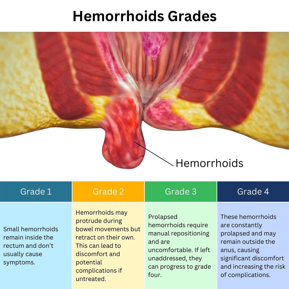 Hemorrhoids Grades