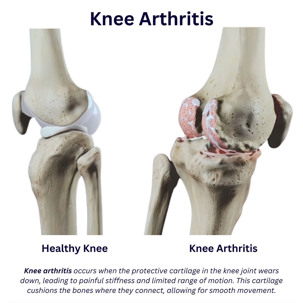 Knee Arthritis