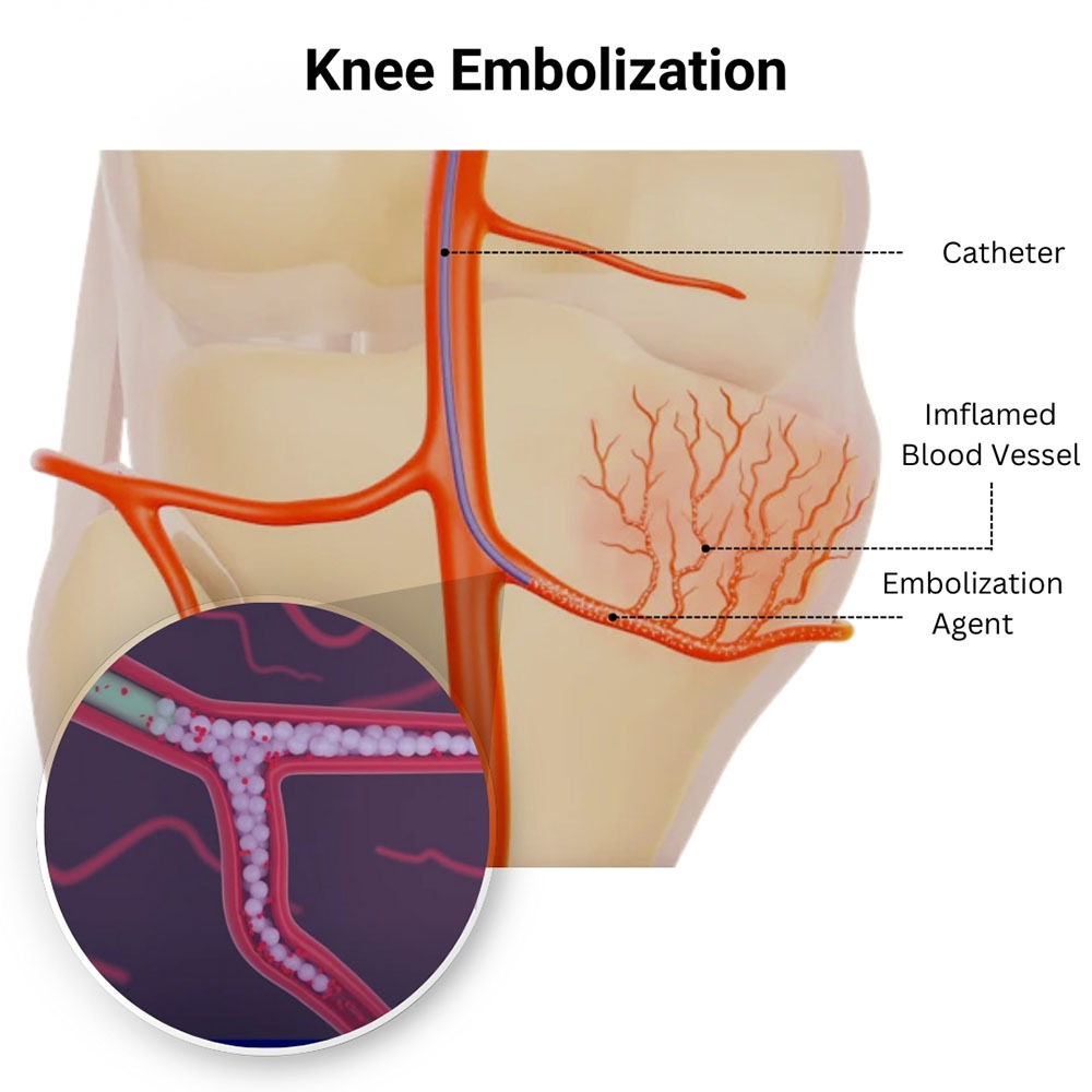 Knee Embolization