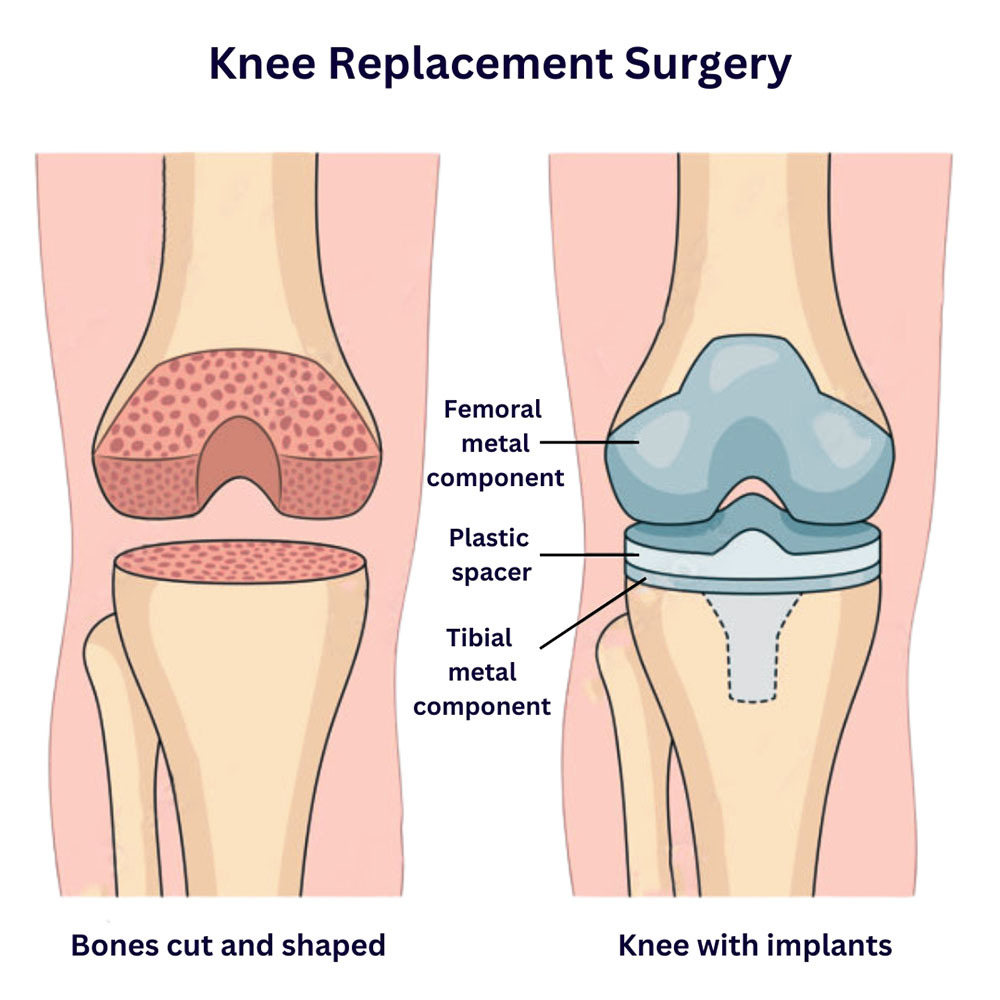 What I Wish I Knew before Knee Replacement Surgery | Vein 